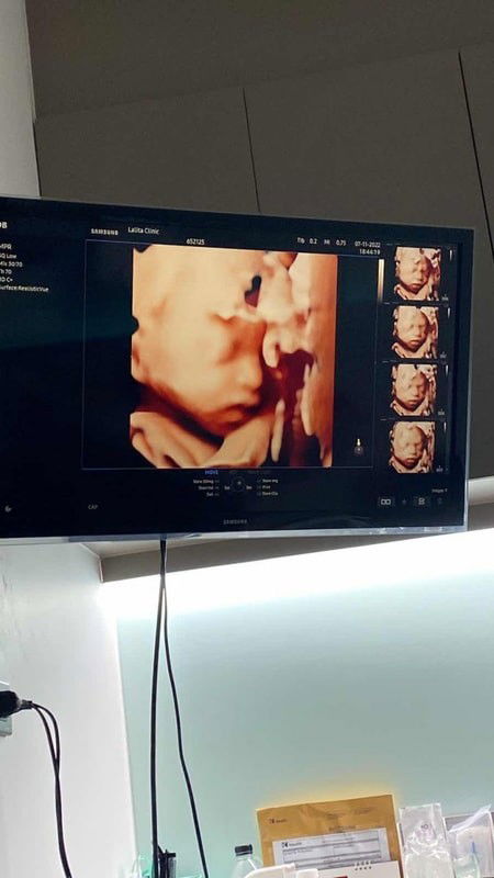 อัลตร้าซาวด์4มิติ 25wค้า