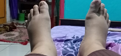 Kaki bengkak setelah melahirkan