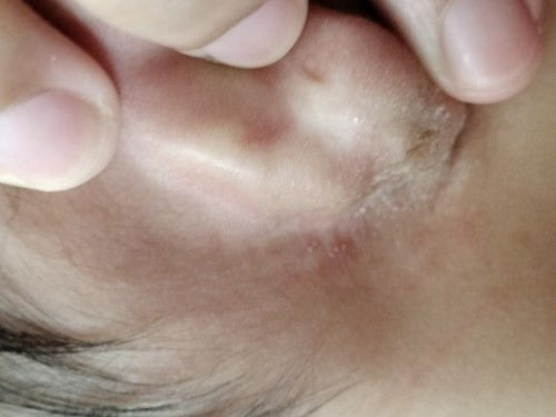 น้องหลังหูแห้ง