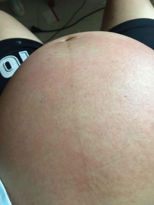 คันหน้าท้องมากเลยค่ะ