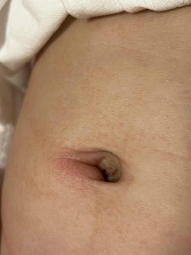 Rash on tummy & side of naval