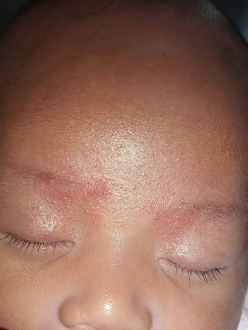 Mengatasi ruam di wajah