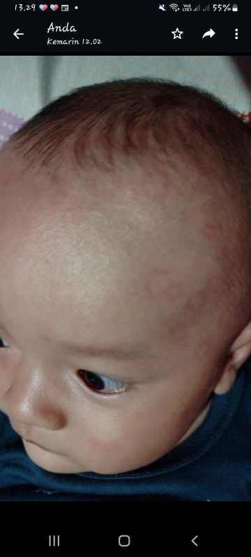 Bintik bintik merah pada bayi 3 bulan