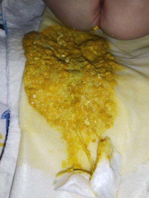 ลูกได้29วันถ่ายแบบนี้ปกติไหมค่ะ