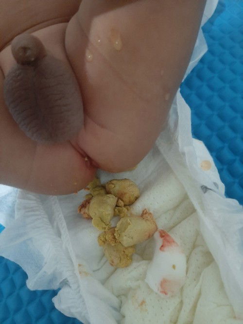 Sobra sa takal sa formula milk o.hindi hiyang sa vitamins??