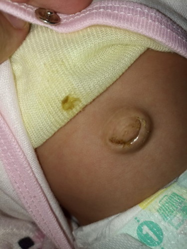 Bun ada yg anak ny kena granuloma?
