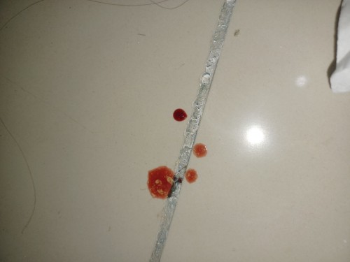 เลือดออก ท้อง8w3D