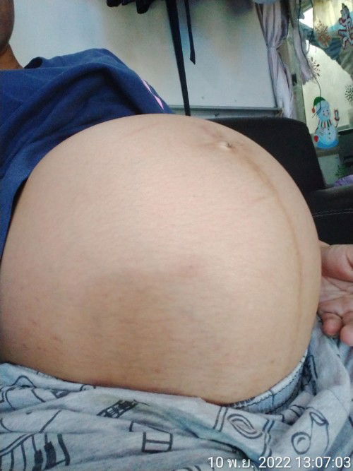 ท้องแข็งเป็นๆหายๆ