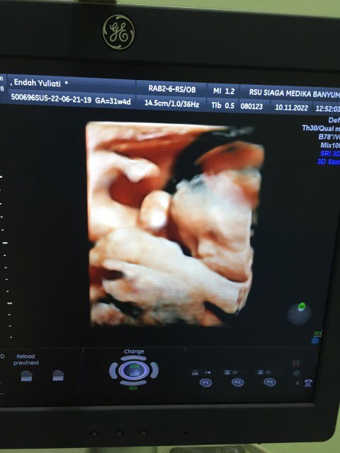 Hasil usg 31 minggu