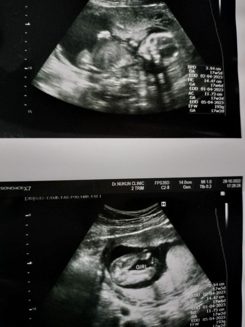 ท้อง19w 4วัน ความรู้สึกแบบนี้ลูกดิ้นไหมคะ