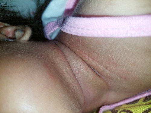 Hello mga mommies. Ano po kaya itong nasa leeg ni baby. Red siya na parang pimples po