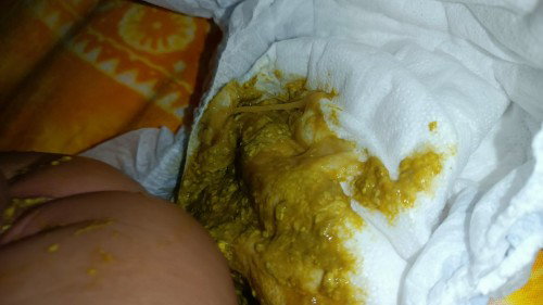 Madalas na pag poops ni baby