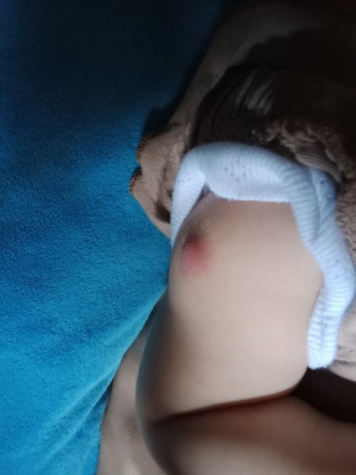 Tanda Bekas Hasil Imunisasi