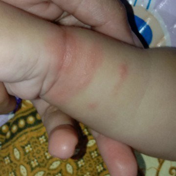 Iritasi di kulit bayi