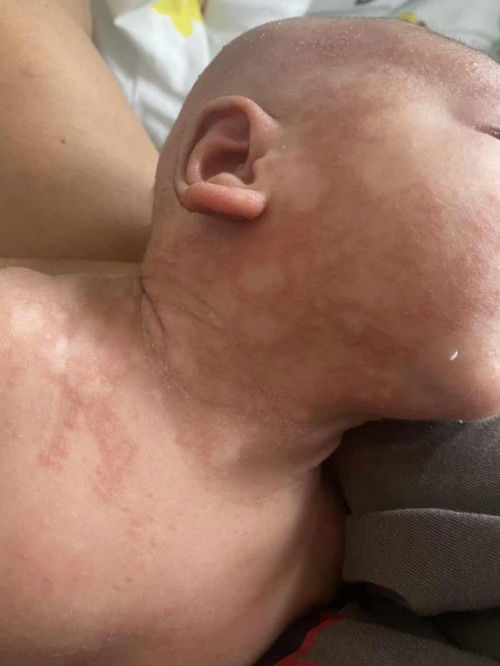 น้องมีผื่นขึ้นที่หน้า คอ หลัง