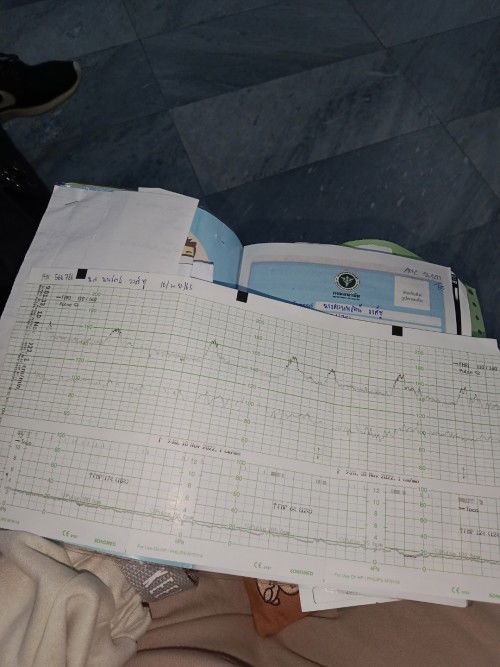 เส้นกราฟดูตรงไหนว่าเรามีอาการท้องแข้งหรือไม่