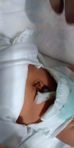 Umbilical Cord