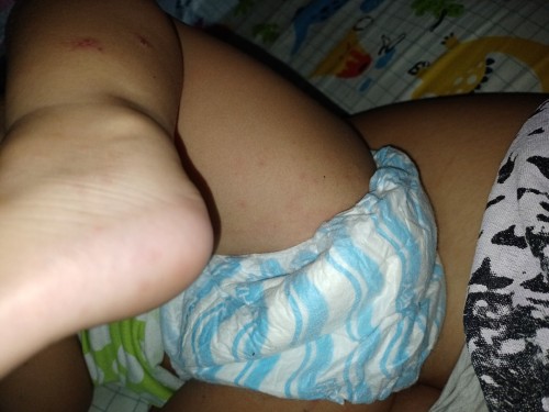 Tigdas hangin po ba ito?Ano po dapat gawin kapag my tigdas hangin ?2yr old na po baby ko...tia
