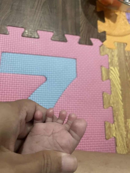 Jempol bayi menggembung