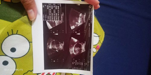 Selisih hpl usg sma hpl hpht