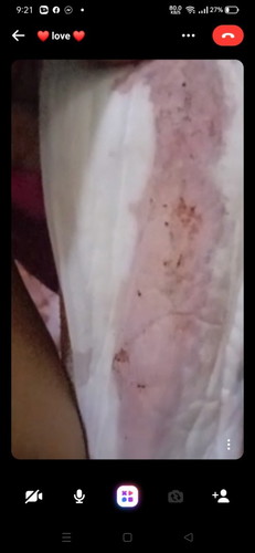 PERIOD.ba o.IMPLANTATION bleeding