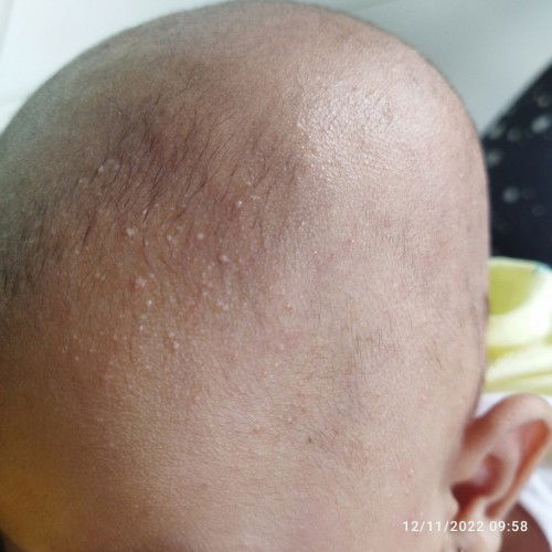 Ini kenapa ya bun.. Bintik2 di kulit bayi.. Bahkan kulit kepala