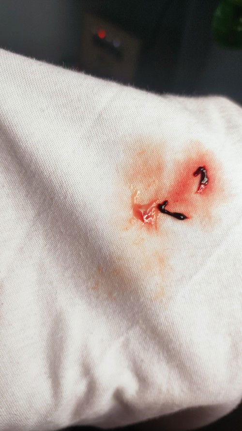 May lumabas na dugo at parang sipon na bloody color