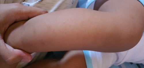 Hi, bungang araw po ba to?