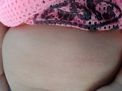 ผื่นแดงที่ท้อง