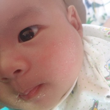 แนะนำยาทาหน่อยค่ะ