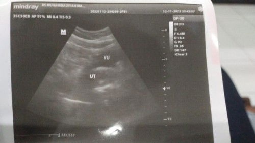 Pertama kali usg, ada yg sama?