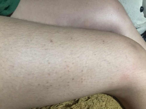 สอบถามแม่ๆที่มีผื่นคัน