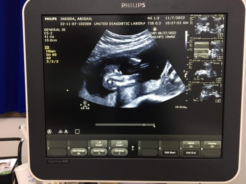 Hello po mga mami boy po ba tong baby ko kasi sabi ng ob boy daw pero wala silang nilagay na boy