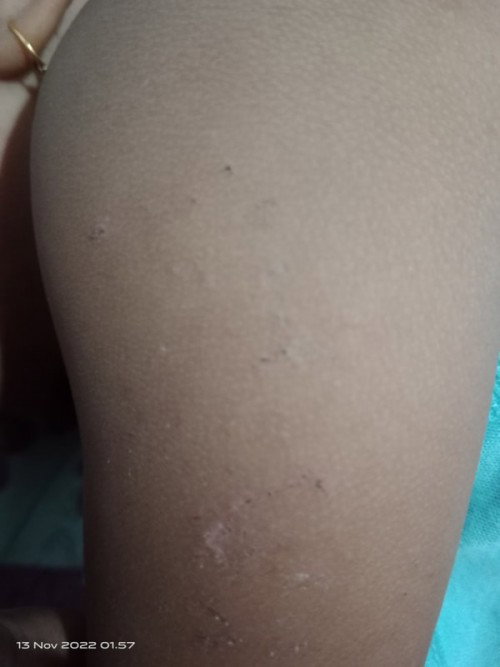Kulit Bayi gatal