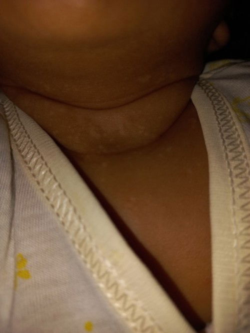 Leher anakku seperti terkena panu ?