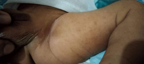 Ano po pwedeng gamot nito?