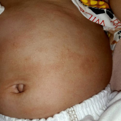 Beruntusan dan ruam merah di perut bany