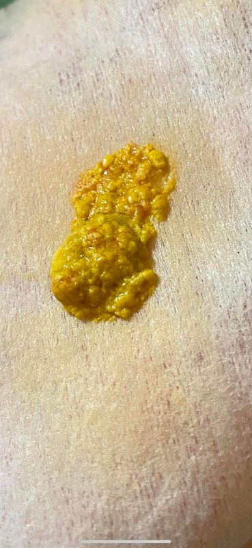 แม่ๆช่วยดูสีอึน้องหน่อยค่ะถ้าผิดปกติจะพาไปหาหมอค่ะ