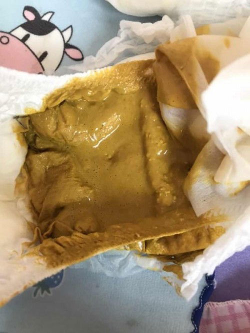 ลูกถ่ายเหลวมาก