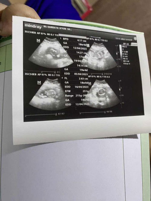 posisi janin melintang