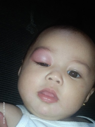 Hello po mga mies.Ano pwdeng gamot parang nakagat po ng insekto ang mata ng baby ko. Nag woworry ako
