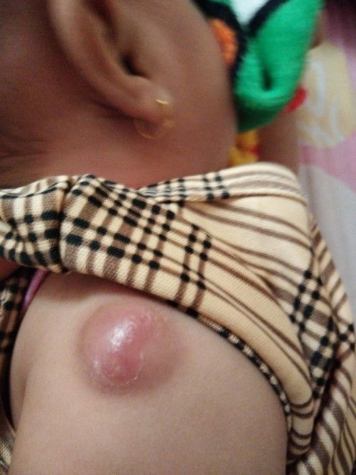 Suntik bcg bengkak bernanah