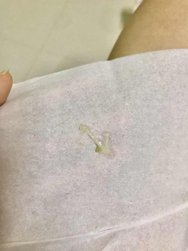 ท้อง12สัปดาห์1วัน ติดโควิดอยู่ด้วย ตื่นมามีมูกแบบนี้ออกมา