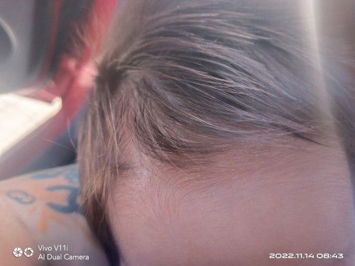 Balakubak sa head ni baby