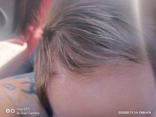 Balakubak sa head ni baby