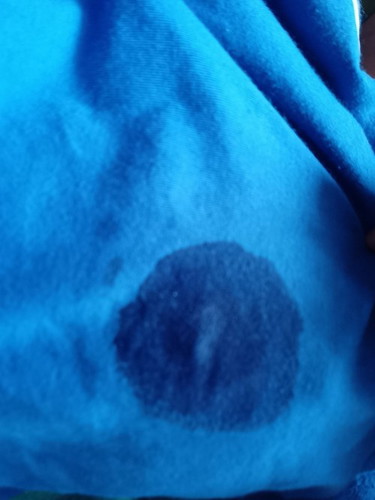 NIPPLE DISCHARGE
