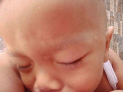 Anu po kaya gamot my puti puti po sya sa mukha sbi po kase nila an an dw po yn