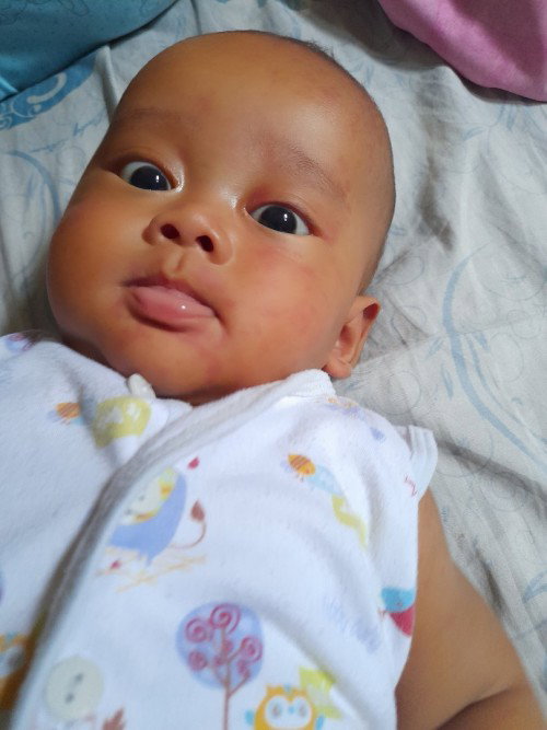 Siang bun mau tanya kira" ini campak atau bukan ya ?