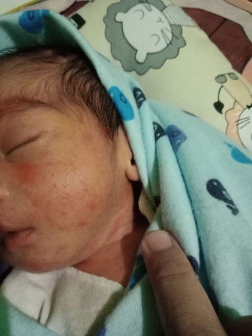 Bintik Merah pada kulit bayi