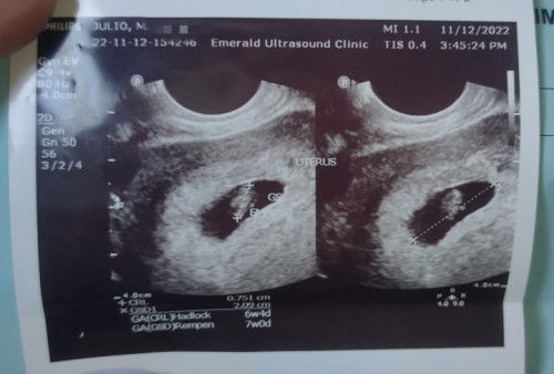 FROM BLIGHTED OVUM NAGPAKITA NA SI BABY